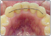 Bonded Retention