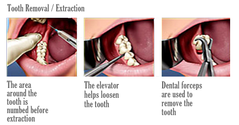wisdom teeth extraction local anesthesia
