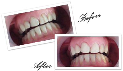 Dentist in Goa for Composite Veneers